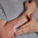 How to GetRid of Psoriasis Naturally?