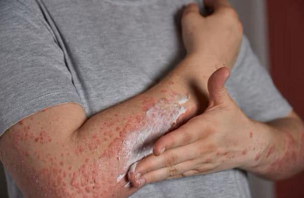 How to GetRid of Psoriasis Naturally?